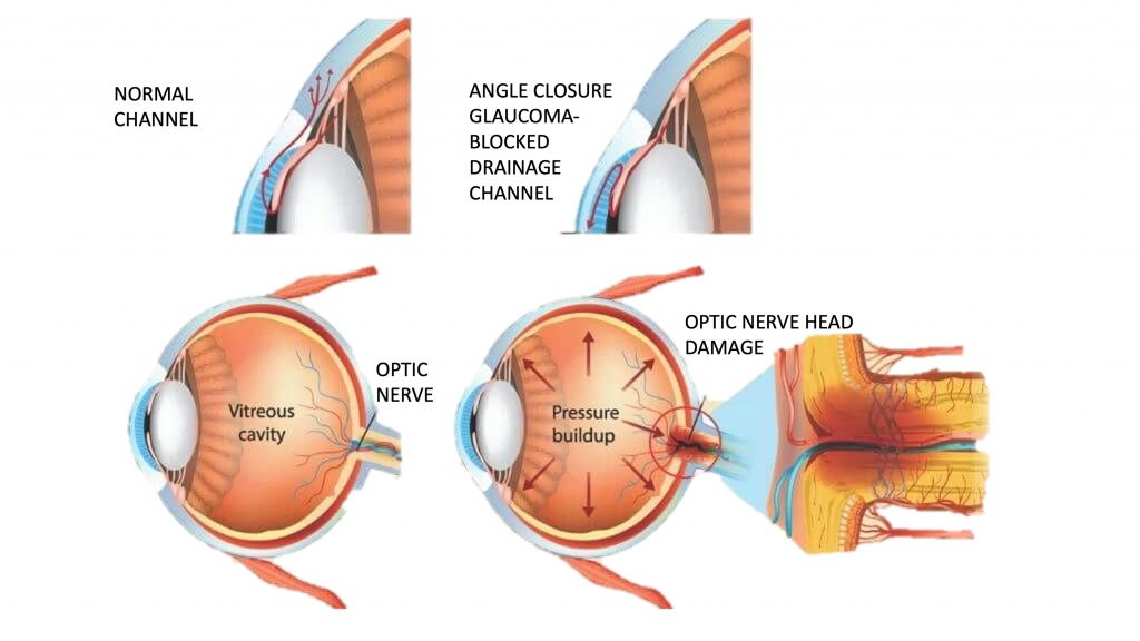 Glaucoma Illustration
